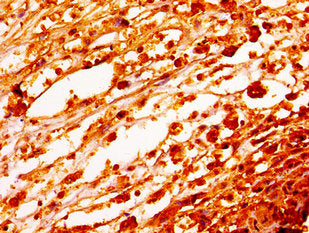 Immunohistochemistry of paraffin-embedded human melanoma using HIST1H1E (Ab-62) Antibody at dilution of 1:100Rabbit anti-Human HIST1H1E Polyclonal Antibody