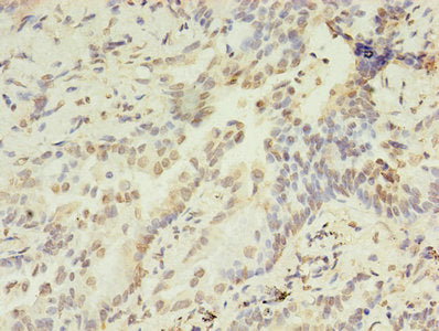 Immunohistochemistry of paraffin-embedded human lung cancer using HIST1H2AG Antibody at dilution of 1:100Rabbit anti-Human HIST1H2AG Polyclonal Antibody