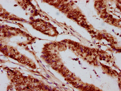 IHC image of the antibody diluted at 1:20 and staining in paraffin-embedded human colon cancer performed on a Leica BondTM system. After dewaxing and hydration, antigen retrieval was mediated by high pressure in a citrate buffer (pH 6.0). Section was blocked with 10% normal goat serum 30min at RT. Then primary antibody (1% BSA) was incubated at 4°C overnight. The primary is detected by a biotinylated secondary antibody and visualized using an HRP conjugated SP system.Rabbit anti-Human HIST1H2AG Polyclonal Antibody