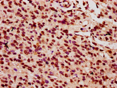 IHC image of HIST1H2AG (Ab-5) Antibody diluted at 1:10 and staining in paraffin-embedded human glioma performed on a Leica BondTM system. After dewaxing and hydration, antigen retrieval was mediated by high pressure in a citrate buffer (pH 6.0). Section was blocked with 10% normal goat serum 30min at RT. Then primary antibody (1% BSA) was incubated at 4°C overnight. The primary is detected by a biotinylated secondary antibody and visualized using an HRP conjugated SP system.Rabbit anti-Human HIST1H2AG Polyclonal Antibody