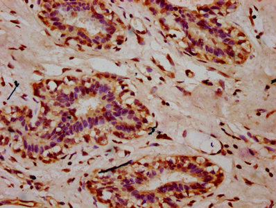 IHC image of the antibody diluted at 1:10 and staining in paraffin-embedded human breast cancer performed on a Leica BondTM system. After dewaxing and hydration, antigen retrieval was mediated by high pressure in a citrate buffer (pH 6.0). Section was blocked with 10% normal goat serum 30min at RT. Then primary antibody (1% BSA) was incubated at 4°C overnight. The primary is detected by a biotinylated secondary antibody and visualized using an HRP conjugated SP system.Rabbit anti-Human HIST1H2AG Polyclonal Antibody