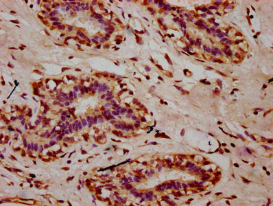 IHC image of the antibody diluted at 1:10 and staining in paraffin-embedded human breast cancer performed on a Leica BondTM system. After dewaxing and hydration, antigen retrieval was mediated by high pressure in a citrate buffer (pH 6.0). Section was blocked with 10% normal goat serum 30min at RT. Then primary antibody (1% BSA) was incubated at 4°C overnight. The primary is detected by a biotinylated secondary antibody and visualized using an HRP conjugated SP system.Rabbit anti-Human HIST1H2AG Polyclonal Antibody