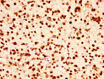IHC image of HIST1H2AG (Ab-9) Antibody diluted at 1:50 and staining in paraffin-embedded human glioma performed on a Leica BondTM system. After dewaxing and hydration, antigen retrieval was mediated by high pressure in a citrate buffer (pH 6.0). Section was blocked with 10% normal goat serum 30min at RT. Then primary antibody (1% BSA) was incubated at 4°C overnight. The primary is detected by a biotinylated secondary antibody and visualized using an HRP conjugated SP system.Rabbit anti-Human HIST1H2AG Polyclonal Antibody