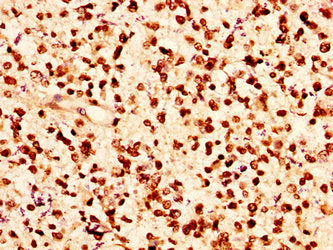 IHC image of HIST1H2AG (Ab-9) Antibody diluted at 1:50 and staining in paraffin-embedded human glioma performed on a Leica BondTM system. After dewaxing and hydration, antigen retrieval was mediated by high pressure in a citrate buffer (pH 6.0). Section was blocked with 10% normal goat serum 30min at RT. Then primary antibody (1% BSA) was incubated at 4°C overnight. The primary is detected by a biotinylated secondary antibody and visualized using an HRP conjugated SP system.Rabbit anti-Human HIST1H2AG Polyclonal Antibody