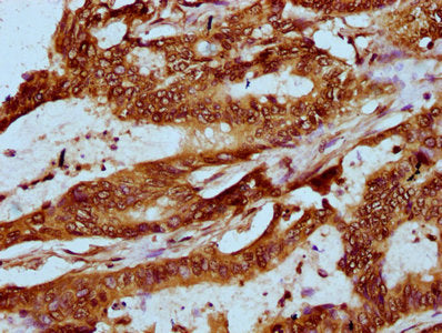 IHC image of HIST1H2AG (Ab-118) Antibody diluted at 1:20 and staining in paraffin-embedded human colon cancer performed on a Leica BondTM system. After dewaxing and hydration, antigen retrieval was mediated by high pressure in a citrate buffer (pH 6.0). Section was blocked with 10% normal goat serum 30min at RT. Then primary antibody (1% BSA) was incubated at 4°C overnight. The primary is detected by a biotinylated secondary antibody and visualized using an HRP conjugated SP system.Rabbit anti-Human HIST1H2AG Polyclonal Antibody