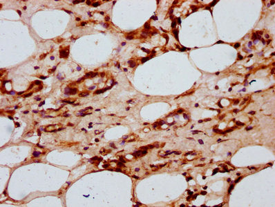 IHC image of HIST1H2AG (Ab-118) Antibody diluted at 1:20 and staining in paraffin-embedded human breast cancer performed on a Leica BondTM system. After dewaxing and hydration, antigen retrieval was mediated by high pressure in a citrate buffer (pH 6.0). Section was blocked with 10% normal goat serum 30min at RT. Then primary antibody (1% BSA) was incubated at 4°C overnight. The primary is detected by a biotinylated secondary antibody and visualized using an HRP conjugated SP system.Rabbit anti-Human HIST1H2AG Polyclonal Antibody