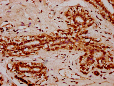 IHC image of HIST1H2AG (Ab-119) Antibody diluted at 1:10 and staining in paraffin-embedded human breast cancer performed on a Leica BondTM system. After dewaxing and hydration, antigen retrieval was mediated by high pressure in a citrate buffer (pH 6.0). Section was blocked with 10% normal goat serum 30min at RT. Then primary antibody (1% BSA) was incubated at 4°C overnight. The primary is detected by a biotinylated secondary antibody and visualized using an HRP conjugated SP system.Rabbit anti-Human HIST1H2AG Polyclonal Antibody