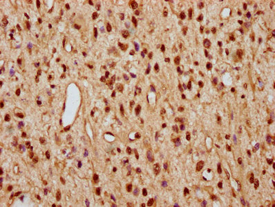 IHC image of HIST1H2AG (Ab-29) Antibody diluted at 1:10 and staining in paraffin-embedded human glioma performed on a Leica BondTM system. After dewaxing and hydration, antigen retrieval was mediated by high pressure in a citrate buffer (pH 6.0). Section was blocked with 10% normal goat serum 30min at RT. Then primary antibody (1% BSA) was incubated at 4°C overnight. The primary is detected by a biotinylated secondary antibody and visualized using an HRP conjugated SP system.Rabbit anti-Human HIST1H2AG Polyclonal Antibody