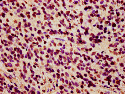 IHC image of HIST1H2AG (Ab-36) Antibody diluted at 1:7 and staining in paraffin-embedded human glioma performed on a Leica BondTM system. After dewaxing and hydration, antigen retrieval was mediated by high pressure in a citrate buffer (pH 6.0). Section was blocked with 10% normal goat serum 30min at RT. Then primary antibody (1% BSA) was incubated at 4°C overnight. The primary is detected by a biotinylated secondary antibody and visualized using an HRP conjugated SP system.Rabbit anti-Human HIST1H2AG Polyclonal Antibody