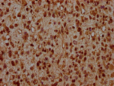 IHC image of the antibody diluted at 1:20 and staining in paraffin-embedded human glioma performed on a Leica BondTM system. After dewaxing and hydration, antigen retrieval was mediated by high pressure in a citrate buffer (pH 6.0). Section was blocked with 10% normal goat serum 30min at RT. Then primary antibody (1% BSA) was incubated at 4°C overnight. The primary is detected by a biotinylated secondary antibody and visualized using an HRP conjugated SP system.Rabbit anti-Human HIST1H2AG Polyclonal Antibody