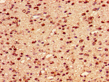 Immunohistochemistry of paraffin-embedded human glioma using the antibody at dilution of 1:100Rabbit anti-Human HIST1H2AG Polyclonal Antibody