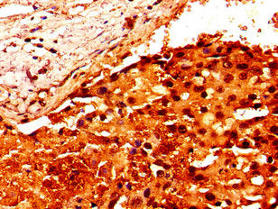 Immunohistochemistry of paraffin-embedded human breast cancer using HIST1H2AG (Ab-101) Antibody at dilution of 1:100Rabbit anti-Human HIST1H2AG Polyclonal Antibody