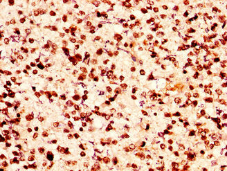 IHC image of HIST1H2AG (Ab-118) Antibody diluted at 1:50 and staining in paraffin-embedded human glioma performed on a Leica BondTM system. After dewaxing and hydration, antigen retrieval was mediated by high pressure in a citrate buffer (pH 6.0). Section was blocked with 10% normal goat serum 30min at RT. Then primary antibody (1% BSA) was incubated at 4°C overnight. The primary is detected by a biotinylated secondary antibody and visualized using an HRP conjugated SP system.Rabbit anti-Human HIST1H2AG Polyclonal Antibody