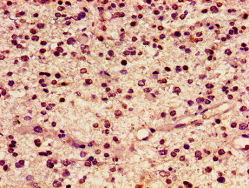 Immunohistochemistry of paraffin-embedded human glioma using the antibody at dilution of 1:100Rabbit anti-Human HIST1H2AG Polyclonal Antibody