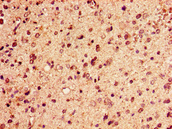 Immunohistochemistry of paraffin-embedded human glioma using the antibody at dilution of 1:100Rabbit anti-Human HIST1H2AG Polyclonal Antibody