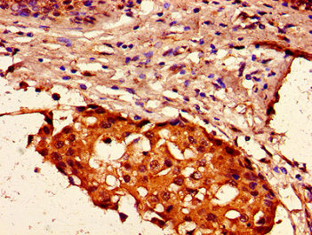 Immunohistochemistry of paraffin-embedded human breast cancer using HIST1H2AG (Ab-125) Antibody at dilution of 1:100Rabbit anti-Human HIST1H2AG Polyclonal Antibody
