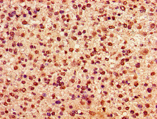 Immunohistochemistry of paraffin-embedded human glioma using HIST1H2AG (Ab-36) Antibody at dilution of 1:100Rabbit anti-Human HIST1H2AG Polyclonal Antibody