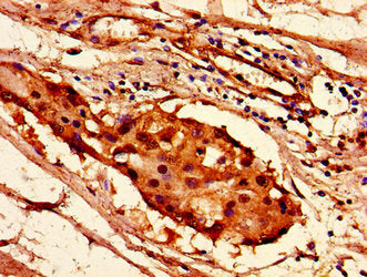 Immunohistochemistry of paraffin-embedded human breast cancer using HIST1H2AG (Ab-36) Antibody at dilution of 1:100Rabbit anti-Human HIST1H2AG Polyclonal Antibody
