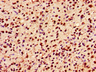Immunohistochemistry of paraffin-embedded human glioma using the antibody at dilution of 1:100Rabbit anti-Human HIST1H2AG Polyclonal Antibody