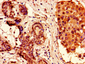 Immunohistochemistry of paraffin-embedded human breast cancer using HIST1H2AG (Ab-36) Antibody at dilution of 1:100Rabbit anti-Human HIST1H2AG Polyclonal Antibody