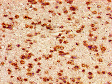 Immunohistochemistry of paraffin-embedded human glioma using the antibody at dilution of 1:100Rabbit anti-Human HIST1H2AG Polyclonal Antibody