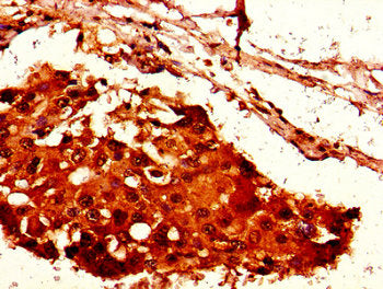 Immunohistochemistry of paraffin-embedded human breast cancer using HIST1H2AG (Ab-95) Antibody at dilution of 1:100Rabbit anti-Human HIST1H2AG Polyclonal Antibody