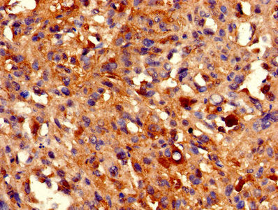 IHC image of HIST1H2BB Antibody diluted at 1:800 and staining in paraffin-embedded human melanoma performed on a Leica BondTM system. After dewaxing and hydration, antigen retrieval was mediated by high pressure in a citrate buffer (pH 6.0). Section was blocked with 10% normal goat serum 30min at RT. Then primary antibody (1% BSA) was incubated at 4°C overnight. The primary is detected by a biotinylated secondary antibody and visualized using an HRP conjugated SP system.Rabbit anti-Human HIST1H2BB Polyclonal Antibody