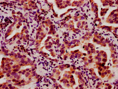IHC image of the antibody diluted at 1:10 and staining in paraffin-embedded human lung cancer performed on a Leica BondTM system. After dewaxing and hydration, antigen retrieval was mediated by high pressure in a citrate buffer (pH 6.0). Section was blocked with 10% normal goat serum 30min at RT. Then primary antibody (1% BSA) was incubated at 4°C overnight. The primary is detected by a biotinylated secondary antibody and visualized using an HRP conjugated SP system.Rabbit anti-Human HIST1H2BC Polyclonal Antibody