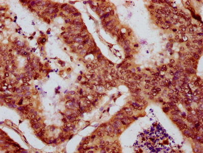 IHC image of HIST1H2BC (Ab-5) Antibody diluted at 1:10 and staining in paraffin-embedded human colon cancer performed on a Leica BondTM system. After dewaxing and hydration, antigen retrieval was mediated by high pressure in a citrate buffer (pH 6.0). Section was blocked with 10% normal goat serum 30min at RT. Then primary antibody (1% BSA) was incubated at 4°C overnight. The primary is detected by a biotinylated secondary antibody and visualized using an HRP conjugated SP system.Rabbit anti-Human HIST1H2BC Polyclonal Antibody