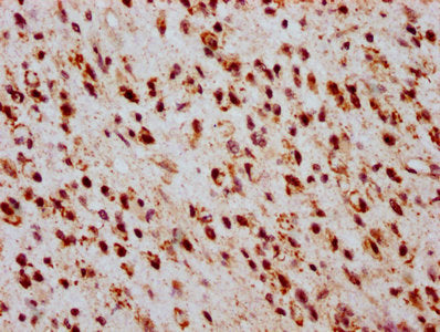 IHC image of the antibody diluted at 1:20 and staining in paraffin-embedded human glioma performed on a Leica BondTM system. After dewaxing and hydration, antigen retrieval was mediated by high pressure in a citrate buffer (pH 6.0). Section was blocked with 10% normal goat serum 30min at RT. Then primary antibody (1% BSA) was incubated at 4°C overnight. The primary is detected by a biotinylated secondary antibody and visualized using an HRP conjugated SP system.Rabbit anti-Human HIST1H2BC Polyclonal Antibody