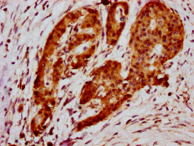 IHC image of HIST1H2BC (Ab-5) Antibody diluted at 1:20 and staining in paraffin-embedded human pancreatic cancer performed on a Leica BondTM system. After dewaxing and hydration, antigen retrieval was mediated by high pressure in a citrate buffer (pH 6.0). Section was blocked with 10% normal goat serum 30min at RT. Then primary antibody (1% BSA) was incubated at 4°C overnight. The primary is detected by a biotinylated secondary antibody and visualized using an HRP conjugated SP system.Rabbit anti-Human HIST1H2BC Polyclonal Antibody