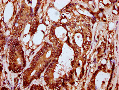 IHC image of HIST1H2BC (Ab-108) Antibody diluted at 1:10 and staining in paraffin-embedded human colon cancer performed on a Leica BondTM system. After dewaxing and hydration, antigen retrieval was mediated by high pressure in a citrate buffer (pH 6.0). Section was blocked with 10% normal goat serum 30min at RT. Then primary antibody (1% BSA) was incubated at 4°C overnight. The primary is detected by a biotinylated secondary antibody and visualized using an HRP conjugated SP system.Rabbit anti-Human HIST1H2BC Polyclonal Antibody