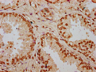 IHC image of HIST1H2BC (Ab-116) Antibody diluted at 1:20 and staining in paraffin-embedded human prostate cancer performed on a Leica BondTM system. After dewaxing and hydration, antigen retrieval was mediated by high pressure in a citrate buffer (pH 6.0). Section was blocked with 10% normal goat serum 30min at RT. Then primary antibody (1% BSA) was incubated at 4°C overnight. The primary is detected by a biotinylated secondary antibody and visualized using an HRP conjugated SP system.Rabbit anti-Human HIST1H2BC Polyclonal Antibody