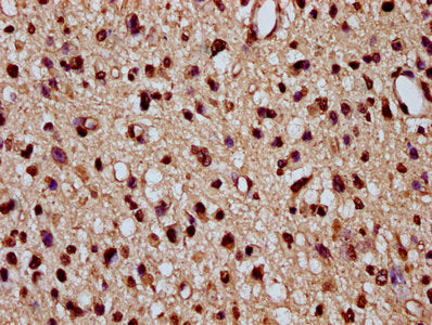 IHC image of HIST1H2BC (Ab-116) Antibody diluted at 1:20 and staining in paraffin-embedded human glioma performed on a Leica BondTM system. After dewaxing and hydration, antigen retrieval was mediated by high pressure in a citrate buffer (pH 6.0). Section was blocked with 10% normal goat serum 30min at RT. Then primary antibody (1% BSA) was incubated at 4°C overnight. The primary is detected by a biotinylated secondary antibody and visualized using an HRP conjugated SP system.Rabbit anti-Human HIST1H2BC Polyclonal Antibody