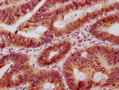 IHC image of HIST1H2BC (Ab-11) Antibody diluted at 1:10 and staining in paraffin-embedded human colon cancer performed on a Leica BondTM system. After dewaxing and hydration, antigen retrieval was mediated by high pressure in a citrate buffer (pH 6.0). Section was blocked with 10% normal goat serum 30min at RT. Then primary antibody (1% BSA) was incubated at 4°C overnight. The primary is detected by a biotinylated secondary antibody and visualized using an HRP conjugated SP system.Rabbit anti-Human HIST1H2BC Polyclonal Antibody