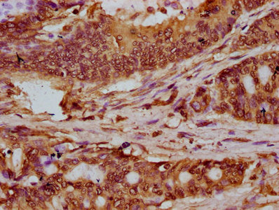 IHC image of HIST1H2BC (Ab-120) Antibody diluted at 1:20 and staining in paraffin-embedded human colon cancer performed on a Leica BondTM system. After dewaxing and hydration, antigen retrieval was mediated by high pressure in a citrate buffer (pH 6.0). Section was blocked with 10% normal goat serum 30min at RT. Then primary antibody (1% BSA) was incubated at 4°C overnight. The primary is detected by a biotinylated secondary antibody and visualized using an HRP conjugated SP system.Rabbit anti-Human HIST1H2BC Polyclonal Antibody