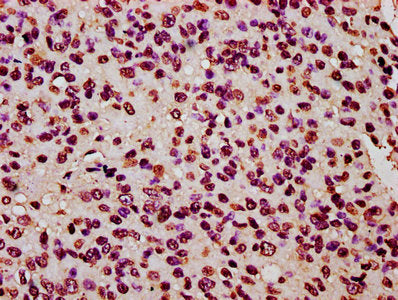 IHC image of HIST1H2BC (Ab-120) Antibody diluted at 1:20 and staining in paraffin-embedded human glioma performed on a Leica BondTM system. After dewaxing and hydration, antigen retrieval was mediated by high pressure in a citrate buffer (pH 6.0). Section was blocked with 10% normal goat serum 30min at RT. Then primary antibody (1% BSA) was incubated at 4°C overnight. The primary is detected by a biotinylated secondary antibody and visualized using an HRP conjugated SP system.Rabbit anti-Human HIST1H2BC Polyclonal Antibody