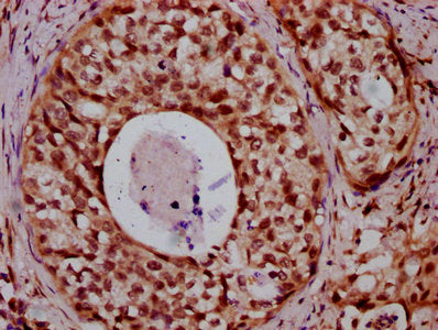 IHC image of HIST1H2BC (Ab-12) Antibody diluted at 1:20 and staining in paraffin-embedded human cervical cancer performed on a Leica BondTM system. After dewaxing and hydration, antigen retrieval was mediated by high pressure in a citrate buffer (pH 6.0). Section was blocked with 10% normal goat serum 30min at RT. Then primary antibody (1% BSA) was incubated at 4°C overnight. The primary is detected by a biotinylated secondary antibody and visualized using an HRP conjugated SP system.Rabbit anti-Human HIST1H2BC Polyclonal Antibody