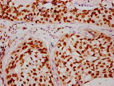 IHC image of HIST1H2BC (Ab-16) Antibody diluted at 1:20 and staining in paraffin-embedded human cervical cancer performed on a Leica BondTM system. After dewaxing and hydration, antigen retrieval was mediated by high pressure in a citrate buffer (pH 6.0). Section was blocked with 10% normal goat serum 30min at RT. Then primary antibody (1% BSA) was incubated at 4°C overnight. The primary is detected by a biotinylated secondary antibody and visualized using an HRP conjugated SP system.Rabbit anti-Human HIST1H2BC Polyclonal Antibody