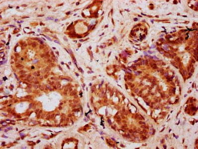 IHC image of the antibody diluted at 1:10 and staining in paraffin-embedded human breast cancer performed on a Leica BondTM system. After dewaxing and hydration, antigen retrieval was mediated by high pressure in a citrate buffer (pH 6.0). Section was blocked with 10% normal goat serum 30min at RT. Then primary antibody (1% BSA) was incubated at 4°C overnight. The primary is detected by a biotinylated secondary antibody and visualized using an HRP conjugated SP system.Rabbit anti-Human HIST1H2BC Polyclonal Antibody