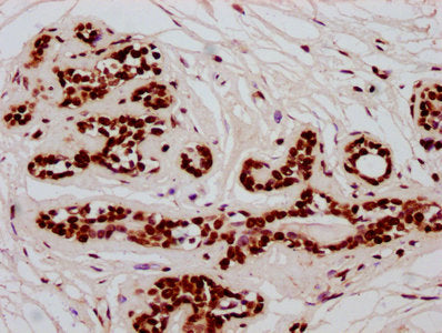 IHC image of HIST1H2BC (Ab-20) Antibody diluted at 1:10 and staining in paraffin-embedded human breast cancer performed on a Leica BondTM system. After dewaxing and hydration, antigen retrieval was mediated by high pressure in a citrate buffer (pH 6.0). Section was blocked with 10% normal goat serum 30min at RT. Then primary antibody (1% BSA) was incubated at 4°C overnight. The primary is detected by a biotinylated secondary antibody and visualized using an HRP conjugated SP system.Rabbit anti-Human HIST1H2BC Polyclonal Antibody