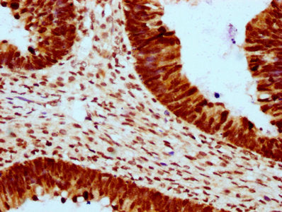 IHC image of the antibody diluted at 1:10 and staining in paraffin-embedded human ovarian cancer performed on a Leica BondTM system. After dewaxing and hydration, antigen retrieval was mediated by high pressure in a citrate buffer (pH 6.0). Section was blocked with 10% normal goat serum 30min at RT. Then primary antibody (1% BSA) was incubated at 4°C overnight. The primary is detected by a biotinylated secondary antibody and visualized using an HRP conjugated SP system.Rabbit anti-Human HIST1H2BC Polyclonal Antibody