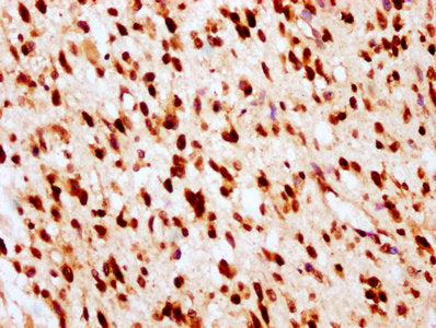 IHC image of HIST1H2BC (Ab-23) Antibody diluted at 1:10 and staining in paraffin-embedded human glioma performed on a Leica BondTM system. After dewaxing and hydration, antigen retrieval was mediated by high pressure in a citrate buffer (pH 6.0). Section was blocked with 10% normal goat serum 30min at RT. Then primary antibody (1% BSA) was incubated at 4°C overnight. The primary is detected by a biotinylated secondary antibody and visualized using an HRP conjugated SP system.Rabbit anti-Human HIST1H2BC Polyclonal Antibody