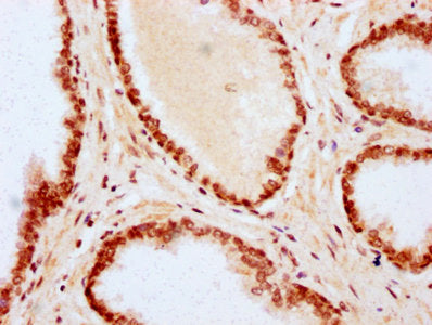 IHC image of the antibody diluted at 1:20 and staining in paraffin-embedded human prostate cancer performed on a Leica BondTM system. After dewaxing and hydration, antigen retrieval was mediated by high pressure in a citrate buffer (pH 6.0). Section was blocked with 10% normal goat serum 30min at RT. Then primary antibody (1% BSA) was incubated at 4°C overnight. The primary is detected by a biotinylated secondary antibody and visualized using an HRP conjugated SP system.Rabbit anti-Human HIST1H2BC Polyclonal Antibody