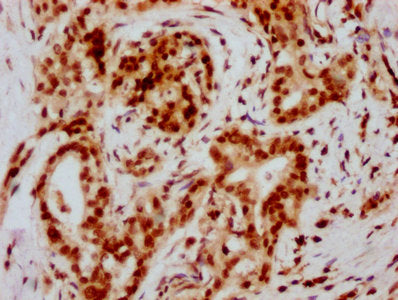 IHC image of HIST1H2BC (Ab-79) Antibody diluted at 1:20 and staining in paraffin-embedded human pancreatic cancer performed on a Leica BondTM system. After dewaxing and hydration, antigen retrieval was mediated by high pressure in a citrate buffer (pH 6.0). Section was blocked with 10% normal goat serum 30min at RT. Then primary antibody (1% BSA) was incubated at 4°C overnight. The primary is detected by a biotinylated secondary antibody and visualized using an HRP conjugated SP system.Rabbit anti-Human HIST1H2BC Polyclonal Antibody