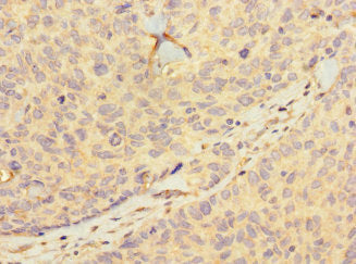 Immunohistochemistry of paraffin-embedded human ovarian cancer using the antibody at dilution of 1:100Rabbit anti-Human HIST1H2BD Polyclonal Antibody