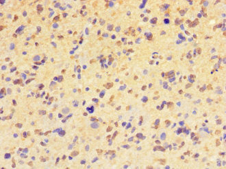 Immunohistochemistry of paraffin-embedded human glioma using HIST1H2BD Antibody at dilution of 1:100Rabbit anti-Human HIST1H2BD Polyclonal Antibody