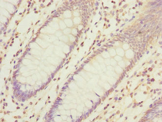 Immunohistochemistry of paraffin-embedded human colon cancer using HIST1H3A Antibody at dilution of 1:100Rabbit anti-Human HIST1H3A Polyclonal Antibody