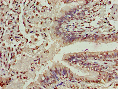 Immunohistochemistry of paraffin-embedded human lung cancer using HIST1H3A (Ab-4) Antibody at dilution of 1:100Rabbit anti-Human HIST1H3A Polyclonal Antibody