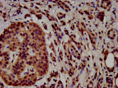 IHC image of HIST1H3A (Ab-4) Antibody diluted at 1:100 and staining in paraffin-embedded human pancreatic cancer performed on a Leica BondTM system. After dewaxing and hydration, antigen retrieval was mediated by high pressure in a citrate buffer (pH 6.0). Section was blocked with 10% normal goat serum 30min at RT. Then primary antibody (1% BSA) was incubated at 4°C overnight. The primary is detected by a biotinylated secondary antibody and visualized using an HRP conjugated SP system.Rabbit anti-Human HIST1H3A Polyclonal Antibody